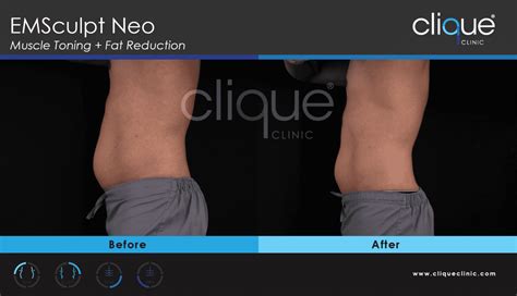 neo sculpting oakdale|EMSCULPT NEO More Muscle Less Fat .